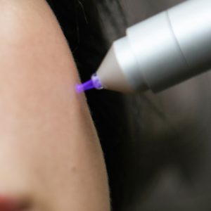 cold-plazma-treatment